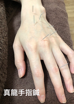 手指鍼療法